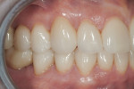 Figure 10 With the maxillary and mandibular restorations seated, the patient has been equilibrated to establish bilateral simultaneous occlusion, demonstrated here by the inter-digitation of the posterior teeth.