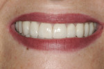 Figure 9 The final restorations in the patient’s smile.