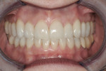 Figure 12 The definitive restorations shown in MIP.