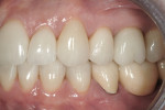 Figure 11 The patient’s left side showing the final restorations in MIP.