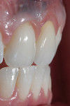 Figure 26  The final re-treatment results, with restored harmony to the smile line and softtissueprofiles.