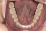 Figure 14 The final restorations on the mandibular arch with anatomy intact. Note the color match of the posterior PFM fixed partial denture on the patient’s left side with the rest of the e.max restorations.