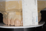 Figure 7 By setting the platform on the articulator, the dental technician was able to first wax the maxillary incisors and cuspid to the appropriate length, and then wax the posterior teeth to level the occlusal plane where possible.