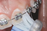 Figure 3 Toothbrush bristle insertion from beneath arch wire, between brackets.