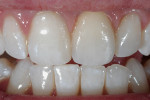Figure 27  The final re-treatment results, with restored harmony to the smile line and soft tissue profiles.