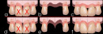 Figure 1 TRIP system and multiple ovate pontics. a-c: tooth extraction results in interproximal bone resorption and black triangle formation. d-f: insertion of biocompatible bars prior to extractions preserves interdental bone and papillae.