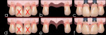 Figure 2 TRIP system and adjacent implants. a-c: tooth extractions and reduced inter-implant distance results in interproximal bone resorption and black triangle formation. d-f: insertion of biocompatible bars prior to extractions associated with adjacent implant placement preserves interdental bone and papillae.