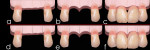 Figure 3 TRIP system and edentulous ridge. a-c: conventional ovate pontic site or implant site development may result in newly shaped interproximal bone resorption and black triangle formation. d-f: insertion of biocompatible bars prior to ovate pontic site or implant site development preserves newly shaped interdental bone and papillae.