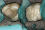 Figure 4  Tooth preparation with glass ionomerbase in place (left). Bulk composite placed inthe preparation after light-polymerization (right).