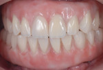 Figure 1 Clinical view of an implant-supported, screw-retained, full-mouth reconstruction.