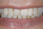 Figure 3 A 70+ year-old-man presented with a poorly designed anterior implant-supported restoration partially disguised by lip position and mobility.