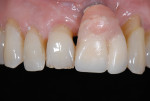 Figure 4 The retracted view reveals poor implant placement planning and restorative design.