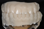 Figure 2 Utilizing temporary abutments and cold-cure acrylic resin, a spare set is ready and available in case repair is needed, providing optimal contingency measurements.