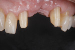 Figure 6 Pragmatism and insufficient space for placing two implants led to the selection of a tooth-supported restoration.