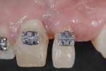 Figure 9 It takes seconds to destroy and sometimes years to reconstruct. This patient had an incorrectly placed implant that created a tremendous defect. Years of surgery and orthodontics were necessary to correct the discrepancy.