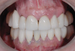 Figure 11 Clinical retracted view of the reconstruction. Notice the uneven gingival margins and the ill-fitting restorations.