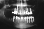 Figure 10 Radiographic view of a heavily restored 37-year-old patient revealing numerous problems associated with the teeth and implant-supported restorations.