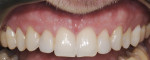 Figure 2 Pretreatment photo of deciduous teeth Nos. 7 and 10 showed developed periodontium and level gingival anterior tissue equal on both sides.