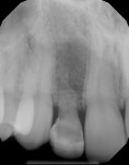 Figure 3 Pretreatment periapical radiograph of site No. 7 revealed signs of root resorption.