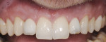 Figure 5 Immediate implants and immediate provisionals in sites Nos. 7 and 10 to maintain gingival architecture. Provisionals at 4 months demonstrated level and equal tissue height on both implants.