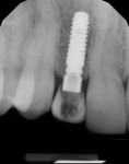 Figure 6 Periapical radiograph of implant provisional at site No. 7 at 4 months.