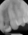 Figure 4 Pretreatment periapical radiograph of site No. 10 revealed signs of root resorption.