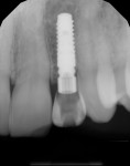 Figure 7 Periapical radiograph of implant provisional at site No. 10 at 4 months.