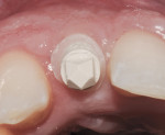 Figure 16 Remove the provisionals and attach the custom scan bodies to the implant sites. Prepare the composite resin collar to the gingival level to provide the laboratory a diagnosed tissue level in the digital impression.
This is a critical step.
