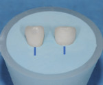 Figure 11 Inject VPS bite registration material to fill cup or two-thirds of the provisional to replicate the tissue portion, and mark a line at mid-facial.