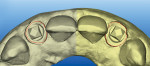 Figure 20 STL files of occlusal view created by itero intraoral digital impression demonstrating the transfer of the anatomical form with a redline at the gingival tissue level created by the custom scan body.