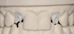 Figure 23 Zirconia abutments placed on
master cast fabricated by CAD/CAM modeling technology of urethane material (itero). Note the accuracy of abutment margins at the gingival level.