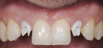 Figure 24 Zirconia abutments directly connected to implant sites Nos. 7 and 10. Note the accuracy of abutment margins at the gingival level.