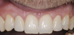 Figure 26 Cement-retained definitive prosthesis at 1 year. Note margins at the gingival level for ease of cement removal.