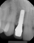 Figure 28 One-year periapical radiograph of definitive implant prosthesis No. 7.