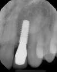 Figure 29 One-year periapical radiograph of definitive implant prosthesis No. 10.