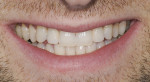 Figure 27 Smile at 1 year.
