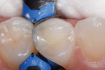 Figure 5 Occlusal
view of the filled cavity preparation after light curing. Note the precision of the fill
and accurate placement of the sectional matrix; this substantially reduced the excess
restorative material, decreasing the chair time needed for finishing and polishing of the
restoration.