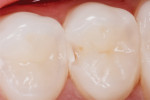 Figure 1 A preoperative occlusal view after initial penetration to a distal proximal carious lesion
on tooth No. 5.