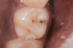 Figure 1 Preoperative photo showing tooth No. 3 with occlusal decay.