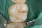Figure 2 The same tooth
shown under a rubber dam prior to decay removal and preparation.
