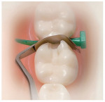Figure 7  The matrix is snapped loose from the wedge on both sides and then shaped to the tooth.