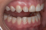 Figure 2 Pretreatment views. Patient presented with darkening of tooth No. 8,
multiple diastemas, and an uneven gingival line.