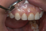 Figure 4 At first restorative appointment, electrosurgery was used to remove and
contour 1.5 mm of free gingiva on the upper right lateral incisor and the upper right
central incisor.
