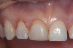 Figure 5 At first restorative appointment, electrosurgery was used to remove and
contour 1.5 mm of free gingiva on the upper right lateral incisor and the upper right
central incisor.