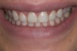Figure 10 During the try-in of the indirect restoration of tooth No. 8, the mesial contour of the upper left central incisor was deemed inadequate.
It was reshaped using the same shade of a universal composite restorative.