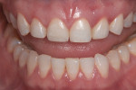 Figure 11 Post-treatment views, in which
all the esthetic concerns of the patient were successfully addressed.
