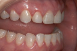 Figure 12 Post-treatment views, in which
all the esthetic concerns of the patient were successfully addressed.