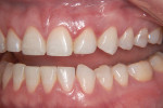 Figure 13 Post-treatment views, in which
all the esthetic concerns of the patient were successfully addressed.