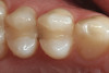 Fig 13. Porcelain-layered zirconia framework (CL-IIIb) with layered pink porcelain for the gingiva (Fig 13); final image in the mouth of the porcelain-layered zirconia framework (Fig 14) (images courtesy of Aram Torosian, MDC).
