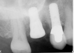 Figure 2 Periapical radiograph of healed maxillary first molar implant.
